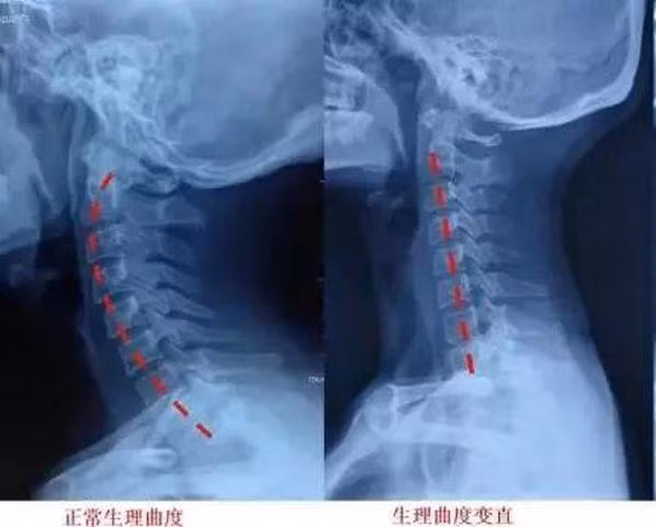  Ảnh chụp X quang cho thấy cột sống cổ của Tiểu Dương chuyển thành đường thẳng đứng và mất đi độ cong sinh học 