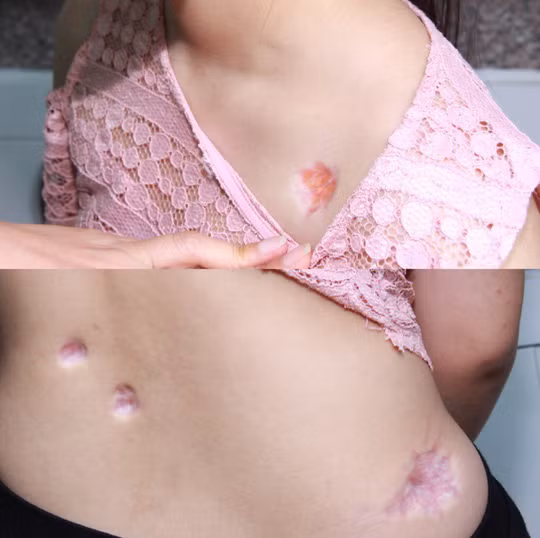 Bị sẹo lõm khắp người sau tiêm thuốc trị sẹo lồi ở thẩm mỹ viện - Ảnh 1.