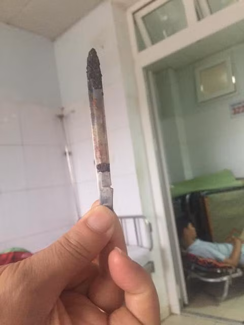 Lưỡi dao được các bác sĩ phẫu thuật lấy ra, dài 13cm, đã hoen gỉ.