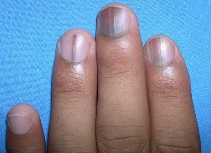 Những dấu hiệu xuất hiện trên móng tay cảnh báo bệnh nguy hiểm 