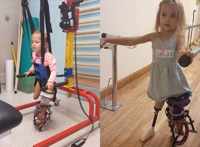 Bé gái chào đời với đôi chân gập hẳn về phía trước giờ ra sao? ảnh 2 be gai chao doi voi doi chan gap han ve phia truoc gio ra sao sau 3 nam? - 2