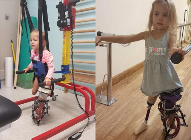 Bé gái chào đời với đôi chân gập hẳn về phía trước giờ ra sao? ảnh 2 be gai chao doi voi doi chan gap han ve phia truoc gio ra sao sau 3 nam? - 2