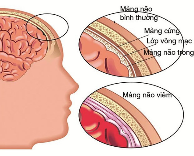 Thấy người con có vết thâm đen lan rộng, mẹ sợ hãi khi biết con mắc bệnh nguy hiểm có thể mất mạng chỉ trong vài giờ - Ảnh 4. Thấy người con có vết thâm đen lan rộng, mẹ sợ hãi khi biết con mắc bệnh nguy hiểm có thể mất mạng chỉ trong vài giờ - Ảnh 4.