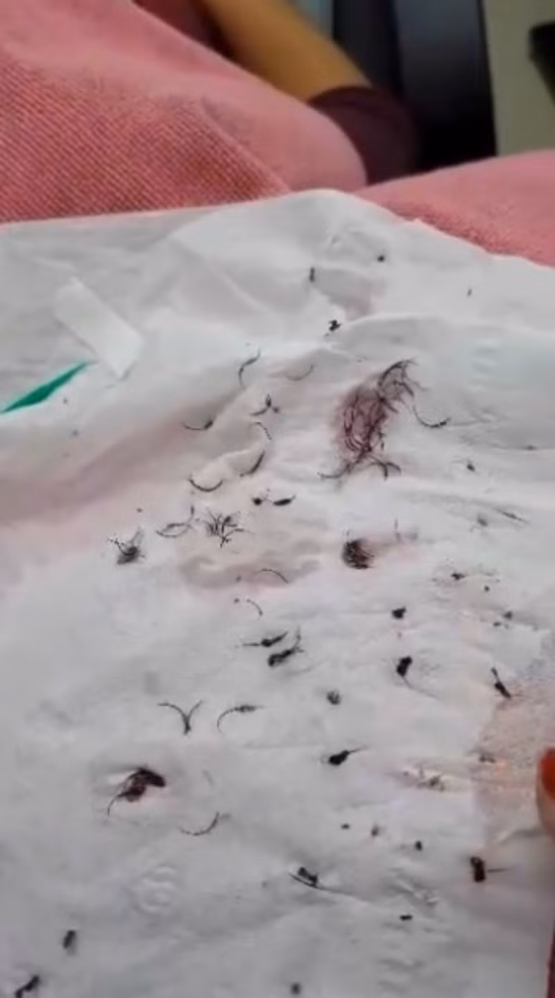 Cô gái đau đớn lĩnh hậu quả với đôi mắt sưng húp, rụng sạch lông mi vì nối mi bằng keo dán sắt - Ảnh 3.