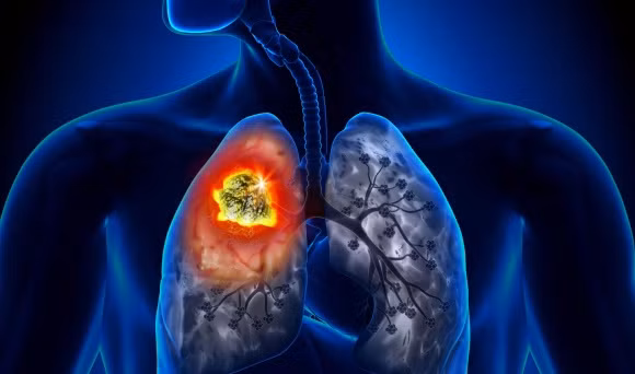 Ung thư phổi, Dấu hiệu mắc Ung thư phổi, Diễn viên Mai Phương mắc ung thư