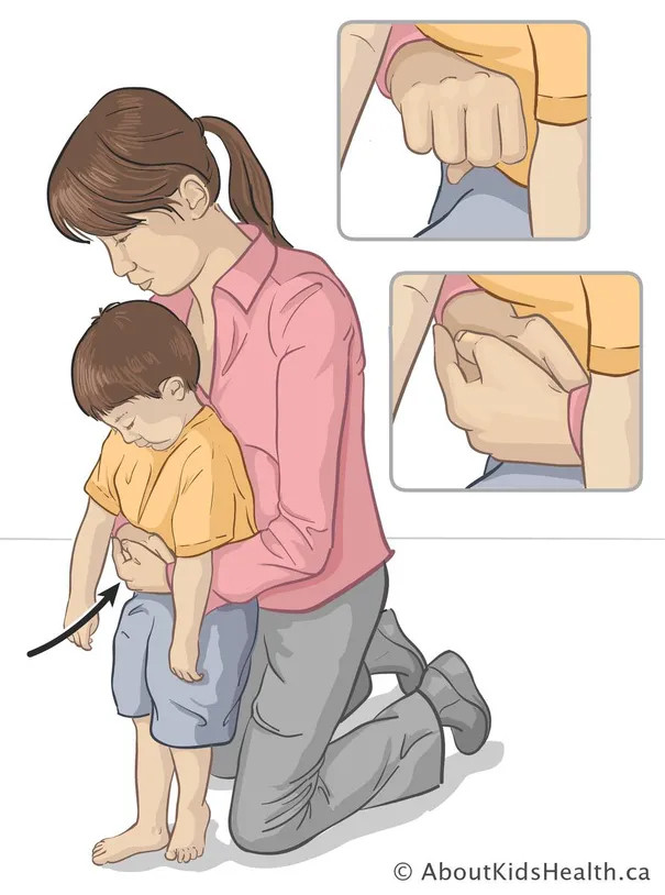 Cách xử lý phù hợp với trẻ bị nghẹn trên một tuổi. (Ảnh: ITN) Cách xử lý phù hợp với trẻ bị nghẹn trên một tuổi. (Ảnh: ITN)