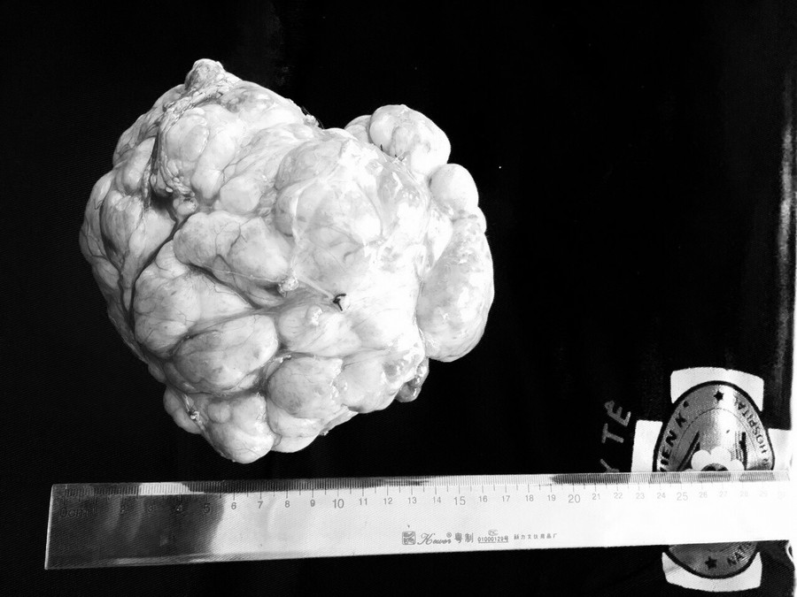 Khối u 3 kg được lấy ra từ ổ bụng bệnh nhân Khối u 3 kg được lấy ra từ ổ bụng bệnh nhân