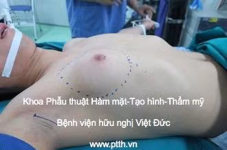 chang trai tre kho so voi bo nguc day dan nhu nu gioi hinh anh 1