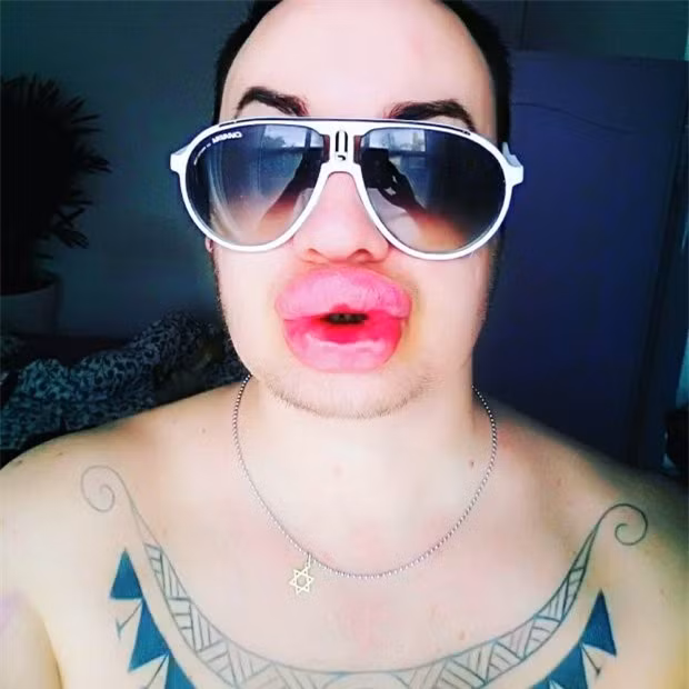 Nghiện phẫu thuật thẩm mỹ, anh chàng bơm môi căng phồng tới hơn 20 lần để nhìn giống... Marilyn Monroe - Ảnh 4.