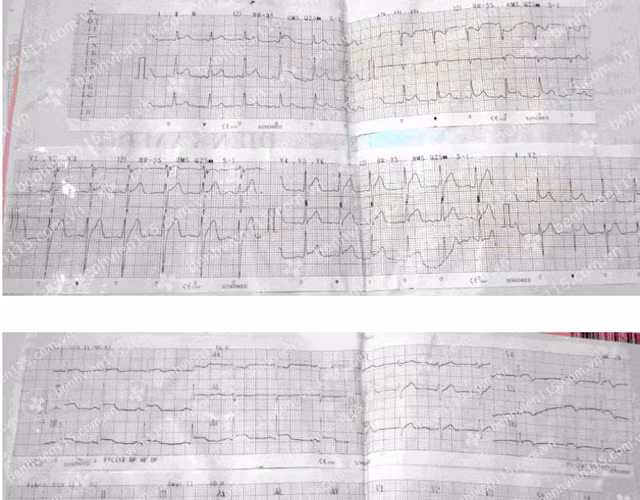 Virus siêu nhỏ nhưng gây viêm cơ tim cấp nguy hiểm
