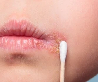 Để loại bỏ mụn rộp