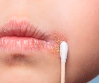 Để loại bỏ mụn rộp