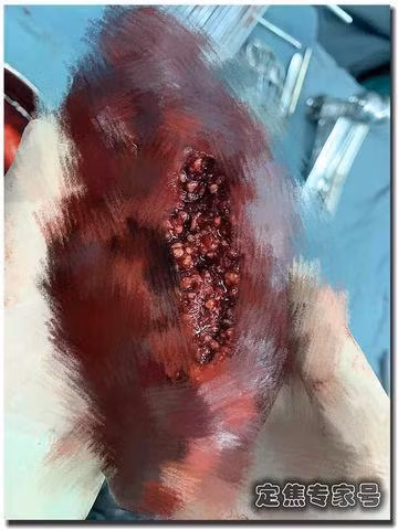 Lá lách của cô gái 28 tuổi như viên gạch rỗ, bác sĩ hãi hùng khi biết lý do ảnh 3 la lach cua co gai 28 tuoi nhu vien gach ro, bac si hai hung khi biet ly do - 4