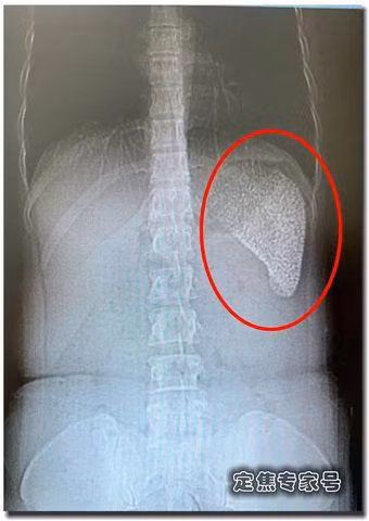Lá lách của cô gái 28 tuổi như viên gạch rỗ, bác sĩ hãi hùng khi biết lý do ảnh 1 la lach cua co gai 28 tuoi nhu vien gach ro, bac si hai hung khi biet ly do - 1