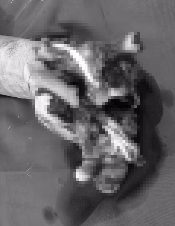 Ăn lẩu bằng bếp gas mini, nhiều người bị nổ nát tay