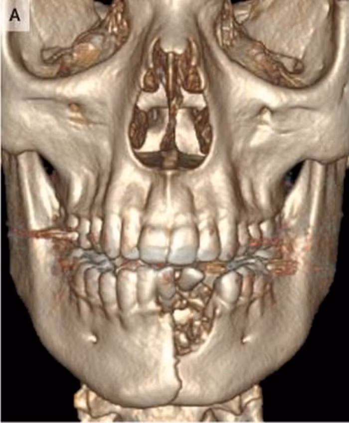 Thuoc la dien tu phat no, mot thieu nien bi vo ham, rung rang hinh anh 1