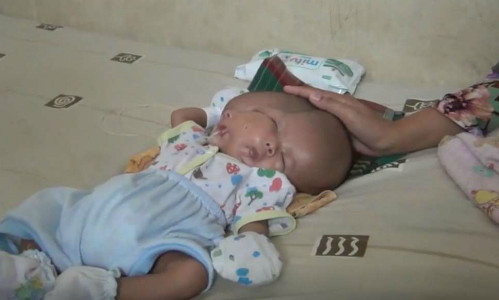Bé Andika hai tháng tuổi sinh ra có hai mặt, hai não. Bé Andika hai tháng tuổi sinh ra có hai mặt, hai não. Ảnh: NF.