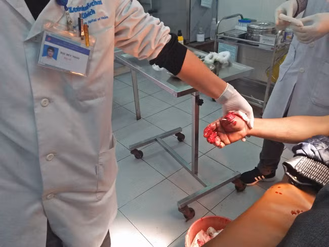 Anh Nguyễn Văn Khương nhập viện trong tình trạng bàn tay phải bị dập, ngón tay cái bị đứt lìa 