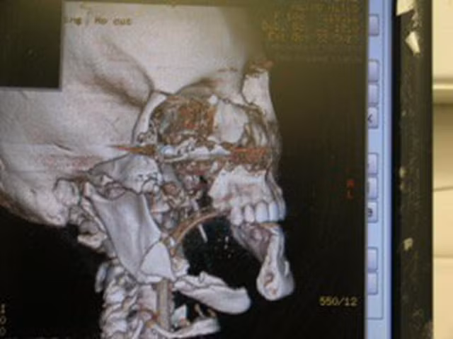 Ảnh chụp X quang phần hộp sọ bị tổn thương của Christen