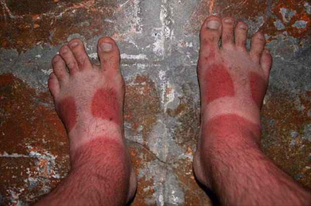 Những thảm cảnh cháy nắng mùa hè khiến bạn không thể yêu thêm những ngày nắng nóng - Ảnh 4.