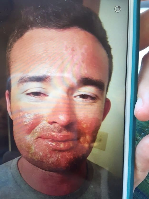 Những thảm cảnh cháy nắng mùa hè khiến bạn không thể yêu thêm những ngày nắng nóng - Ảnh 10.