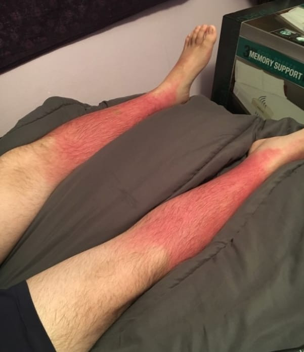 Những thảm cảnh cháy nắng mùa hè khiến bạn không thể yêu thêm những ngày nắng nóng - Ảnh 15.