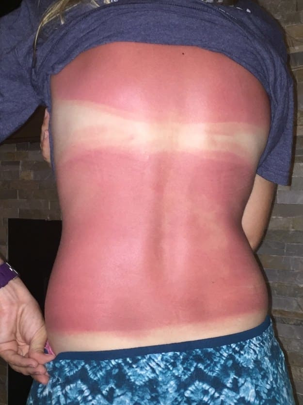 Những thảm cảnh cháy nắng mùa hè khiến bạn không thể yêu thêm những ngày nắng nóng - Ảnh 17.