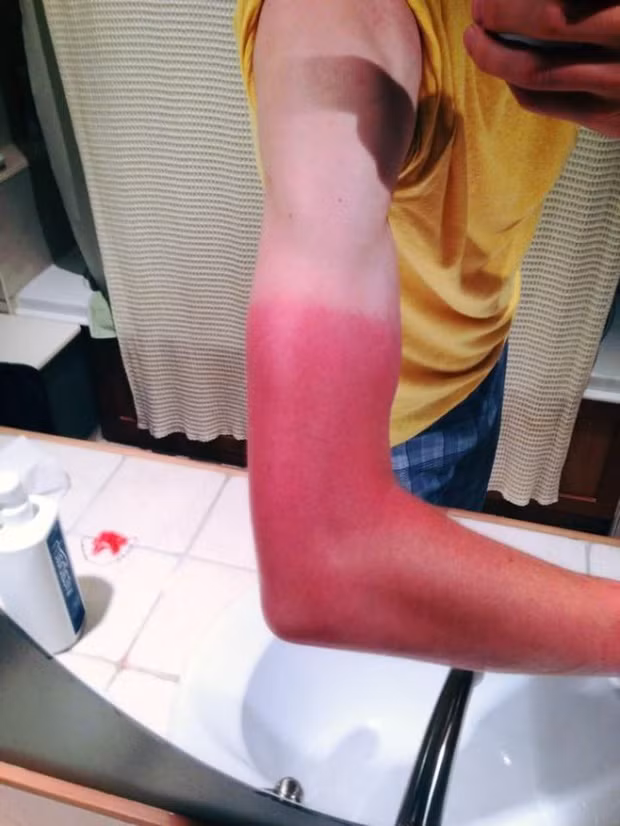 Những thảm cảnh cháy nắng mùa hè khiến bạn không thể yêu thêm những ngày nắng nóng - Ảnh 13.