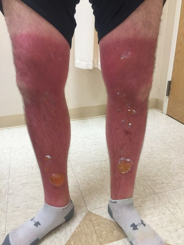 Những thảm cảnh cháy nắng mùa hè khiến bạn không thể yêu thêm những ngày nắng nóng - Ảnh 14.