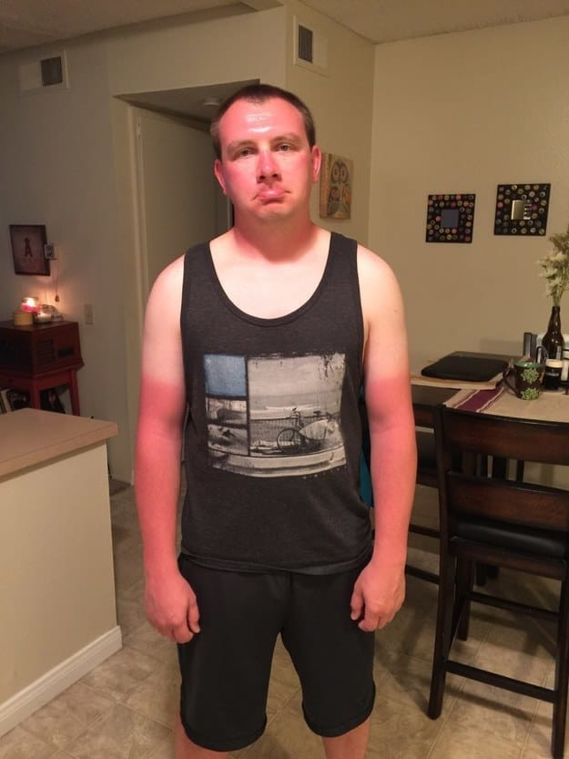 Những thảm cảnh cháy nắng mùa hè khiến bạn không thể yêu thêm những ngày nắng nóng - Ảnh 2.