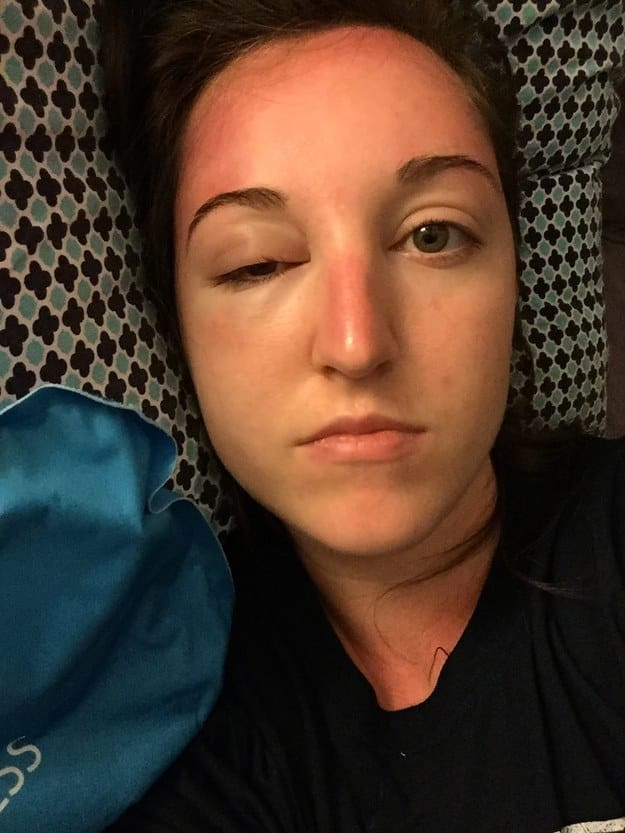 Những thảm cảnh cháy nắng mùa hè khiến bạn không thể yêu thêm những ngày nắng nóng - Ảnh 6.