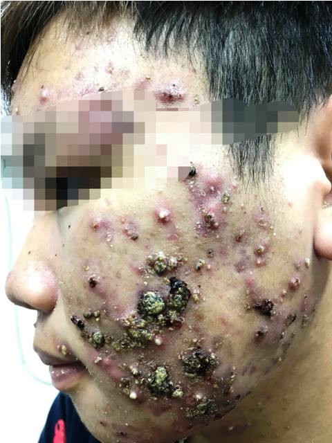 Bôi kem trộn, mặt thiếu nữ sưng vù, chi chít mụn mủ chưa từng thấy-3