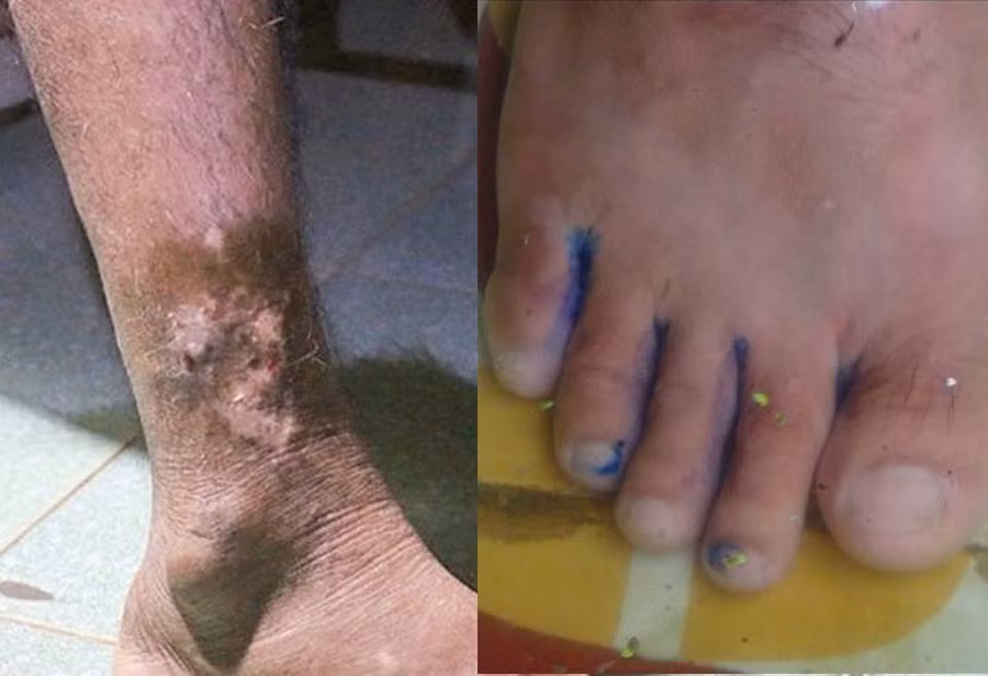 Đi lại trong vùng ngập lụt lâu ngày làm nhiều người dân ở Chương Mỹ, Hà Nội mắc bệnh da liễu