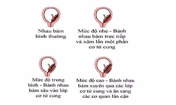 me bau dong nai nhap vien cap cuu, bac si cang nao khi nhin vao tu cung san phu - 1