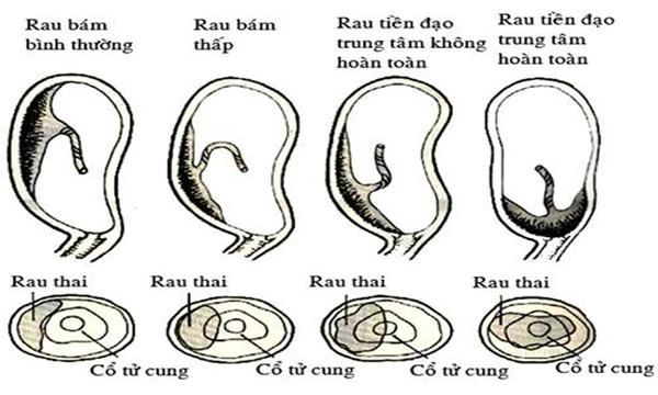 Mẹ bầu nhập viện cấp cứu, bác sĩ căng não khi nhìn vào tử cung sản phụ