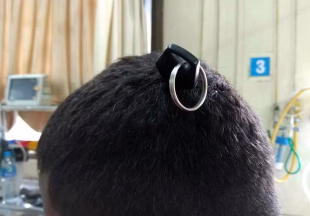 Hy hữu: Bị chìa khóa cắm thẳng vào đầu - não không tổn thương, chìa vẫn hoạt động tốt!