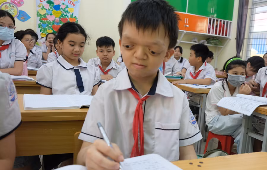 Vũ mang hội chứng Cruzon và phải trải qua hai cuộc đại phẫu thuật khiến sức khoẻ em rất yếu, tai nghe kém và mắt lồi ra. (Ảnh: NT).