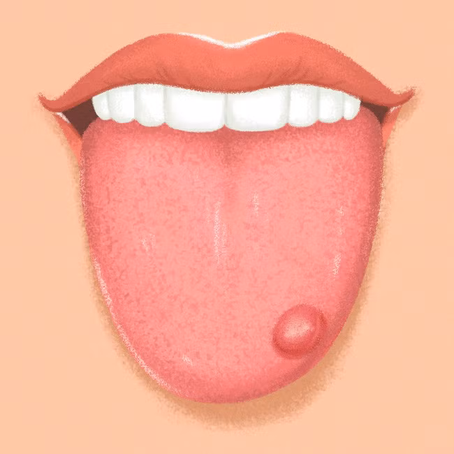 9 dấu hiệu xuất hiện trên lưỡi cảnh báo sức khỏe nguy hiểm ảnh 6