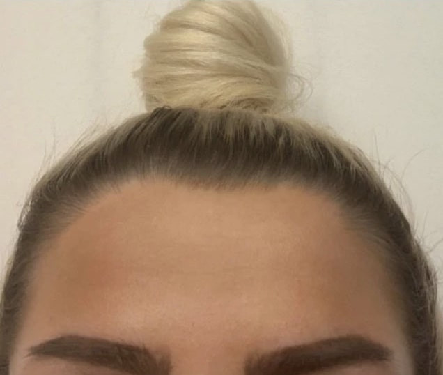 Hot girl tiêm filler để có gương mặt con nhà giàu như Kylie Jenner ảnh 4 Hot girl tiem filler de co guong mat con nha giau nhu Kylie Jenner hinh anh 4