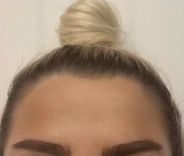 Hot girl tiem filler de co guong mat con nha giau nhu Kylie Jenner hinh anh 4 