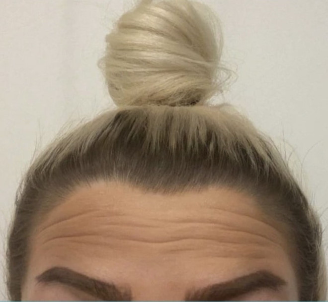 Hot girl tiêm filler để có gương mặt con nhà giàu như Kylie Jenner ảnh 3 Hot girl tiem filler de co guong mat con nha giau nhu Kylie Jenner hinh anh 3