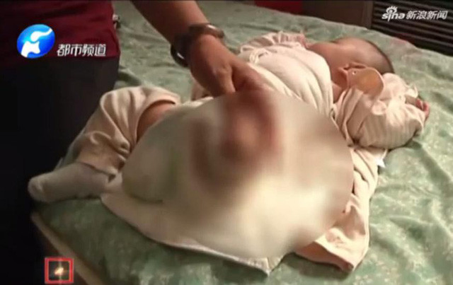 Y tá quên tắt máy sấy tóc, bé sơ sinh bỏng nặng tới nỗi phải cưa chân ảnh 1 Bé sơ sinh đã bị cắt cụt một chân