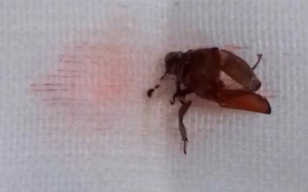 Bé trai suýt thủng màng nhĩ vì bọ cánh cứng chui vào tai ảnh 1