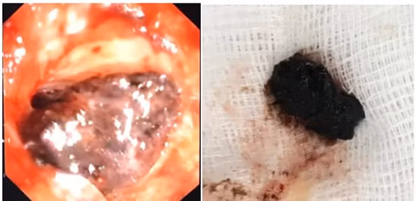 Hai bệnh viện hợp sức “giải cứu” cụ bà 77 tuổi hóc hạt ô mai ảnh 1