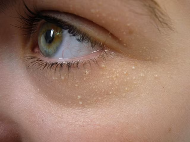 Lưu ý ngay những điều sau để việc nặn mụn không gây ra những hậu quả nghiêm trọng - Hình 5