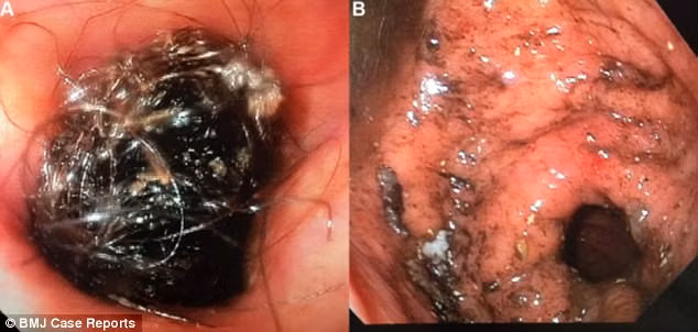 Vì thói quen kì quái, người phụ nữ khiến bác sĩ sốc khi lấy ra vật này trong dạ dày - Ảnh 2.