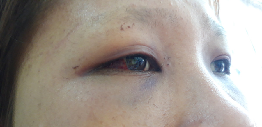 Vết thương vùng mắt phải khiến em không nhìn rõ mọi vật. Vết thương vùng mắt phải khiến em không nhìn rõ mọi vật.