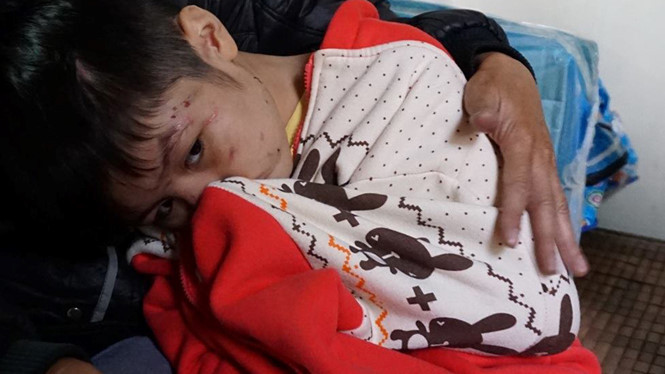 Khuôn mặt bé T.G.K rất nhiều sẹo. Ảnh: Thanh Niên.