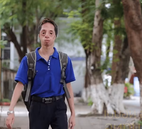 Anh chàng cựu sinh viên giỏi đặc biệt của đại học Bách Khoa: Không có tai, gương mặt đặc biệt nhưng nghị lực phi thường