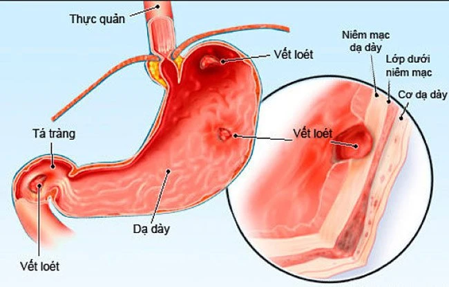 4 thứ đại kị với dạ dày, tránh ăn thường xuyên kẻo cả bụng nóng ran